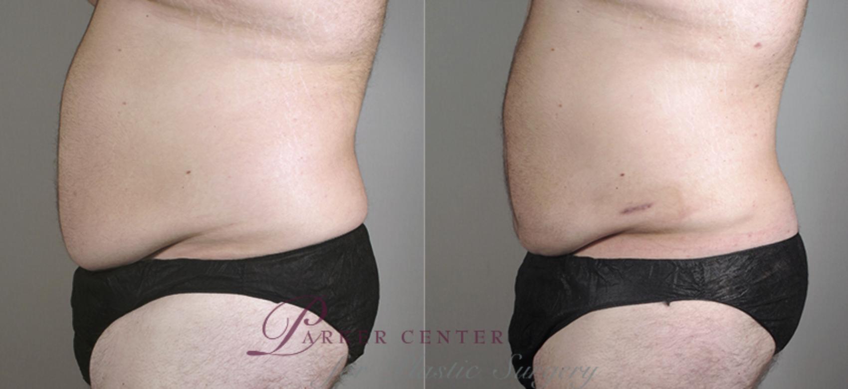 Liposuction Case 795 Before & After View #2 | Paramus, NJ | Parker Center for Plastic Surgery