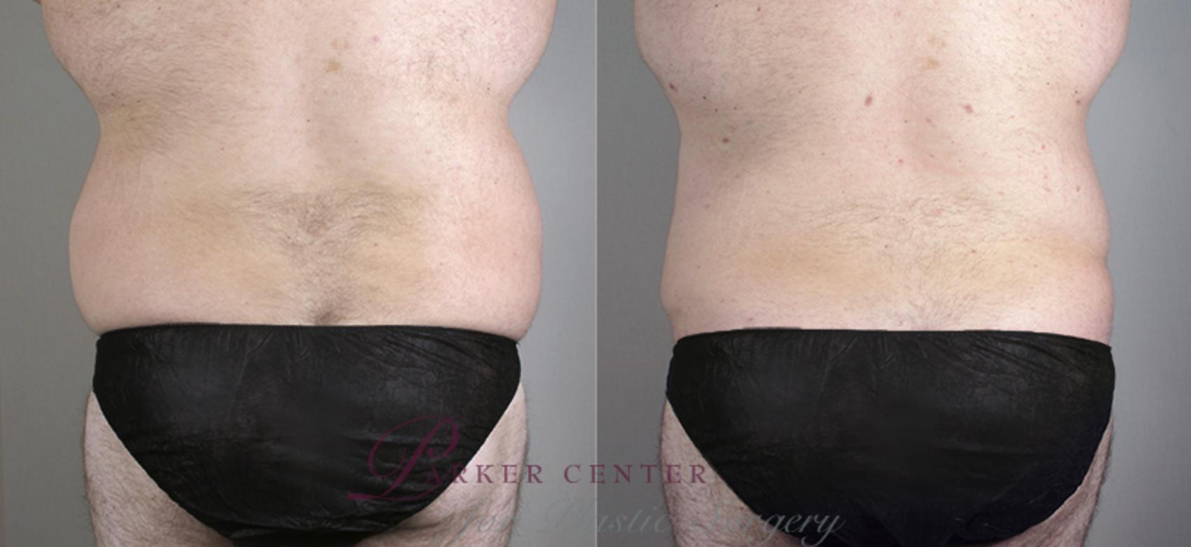 Liposuction Case 795 Before & After View #3 | Paramus, NJ | Parker Center for Plastic Surgery