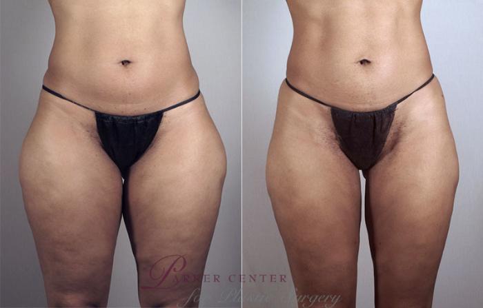 Liposuction Case 796 Before & After View #1 | Paramus, NJ | Parker Center for Plastic Surgery