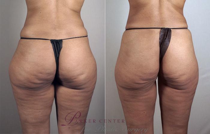 Liposuction Case 796 Before & After View #2 | Paramus, NJ | Parker Center for Plastic Surgery