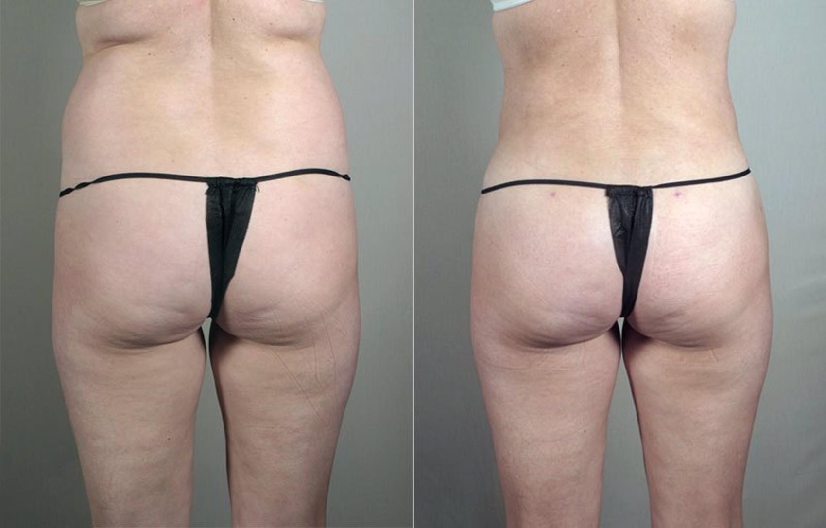 Liposuction Case 797 Before & After View #1 | Paramus, NJ | Parker Center for Plastic Surgery