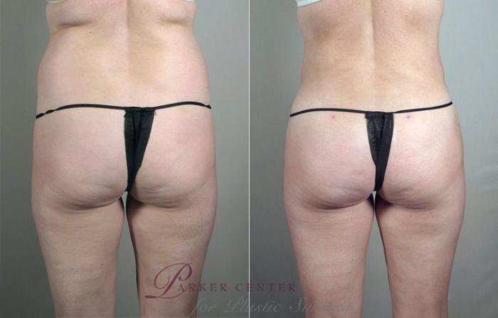 Liposuction Case 797 Before & After View #1 | Paramus, NJ | Parker Center for Plastic Surgery