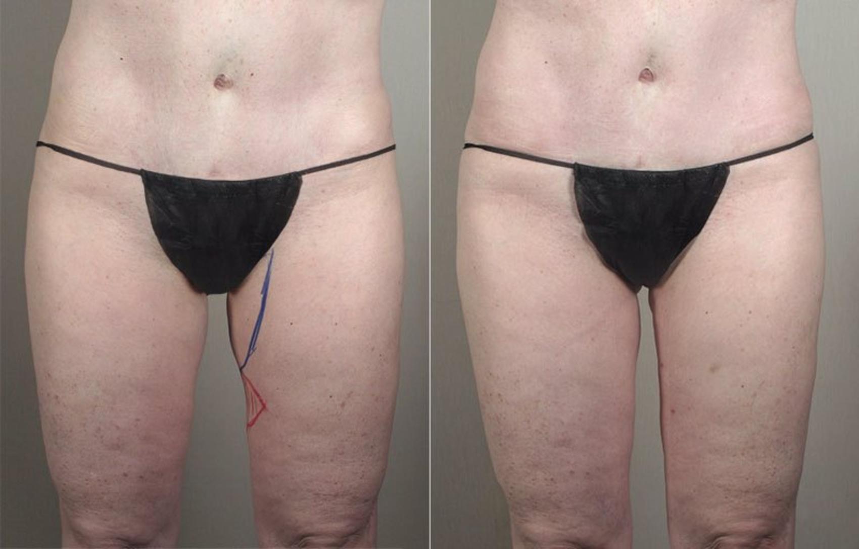 Liposuction Case 798 Before & After View #2 | Paramus, NJ | Parker Center for Plastic Surgery