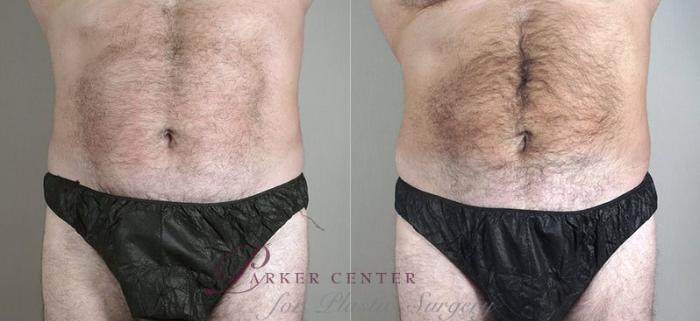 Liposuction Case 800 Before & After View #1 | Paramus, NJ | Parker Center for Plastic Surgery