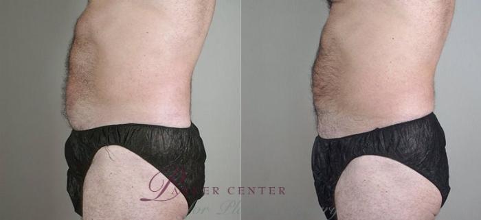 Liposuction Case 800 Before & After View #2 | Paramus, NJ | Parker Center for Plastic Surgery