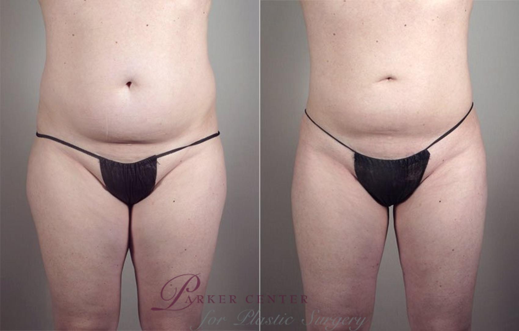 Liposuction Case 801 Before & After View #1 | Paramus, NJ | Parker Center for Plastic Surgery