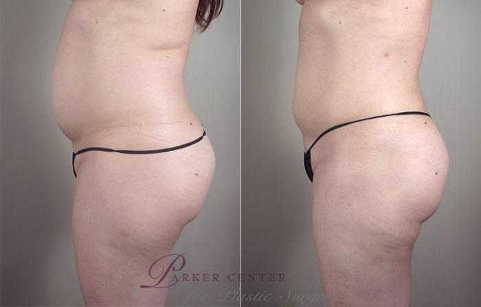 Liposuction Case 801 Before & After View #2 | Paramus, NJ | Parker Center for Plastic Surgery
