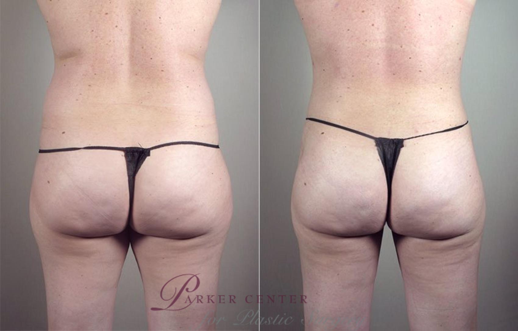 Liposuction Case 801 Before & After View #3 | Paramus, New Jersey | Parker Center for Plastic Surgery
