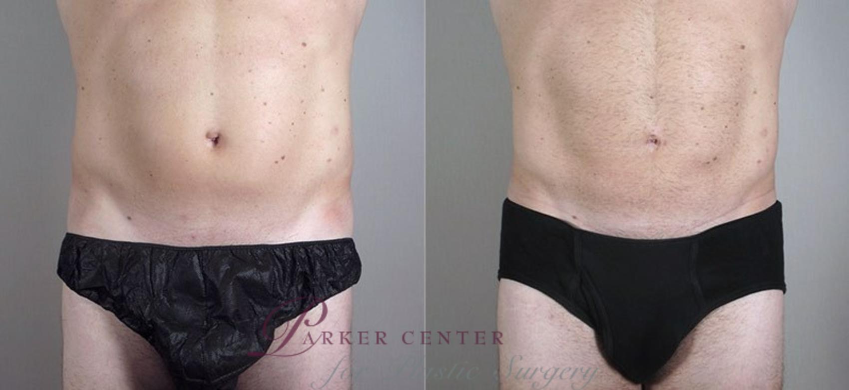 Liposuction Case 802 Before & After View #1 | Paramus, NJ | Parker Center for Plastic Surgery