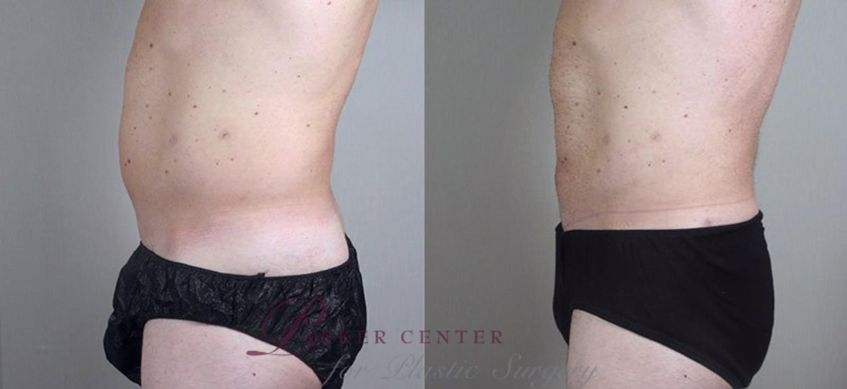 Liposuction Case 802 Before & After View #2 | Paramus, NJ | Parker Center for Plastic Surgery