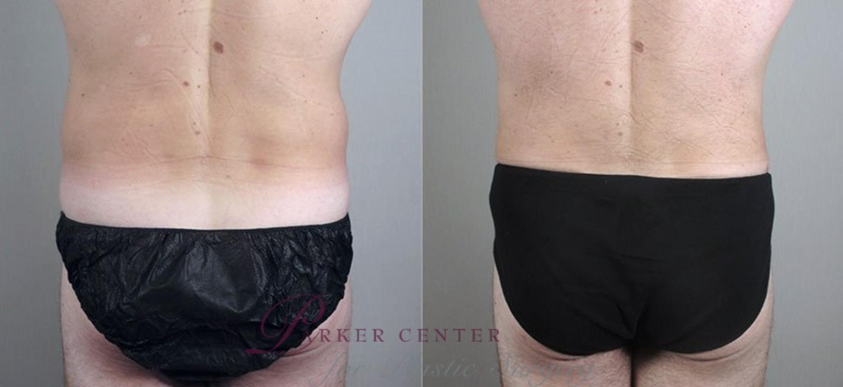 Liposuction Case 802 Before & After View #3 | Paramus, NJ | Parker Center for Plastic Surgery