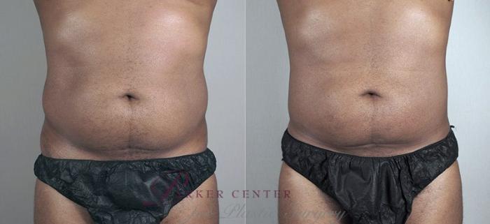 Liposuction Case 804 Before & After View #1 | Paramus, NJ | Parker Center for Plastic Surgery