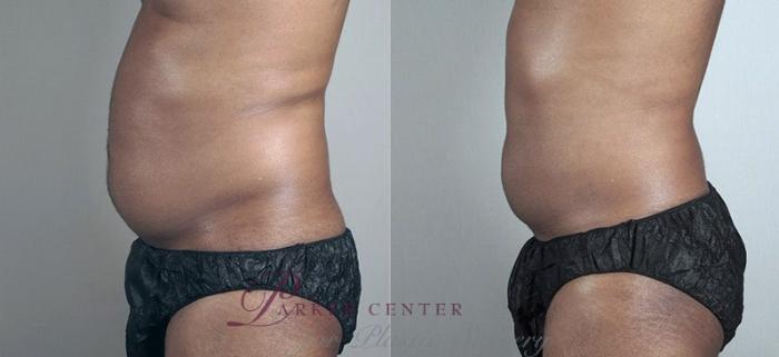 Liposuction Case 804 Before & After View #2 | Paramus, NJ | Parker Center for Plastic Surgery