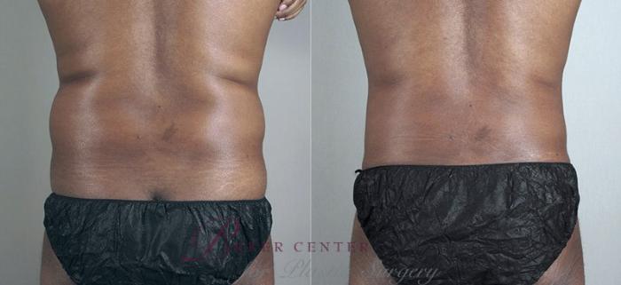 Liposuction Case 804 Before & After View #3 | Paramus, NJ | Parker Center for Plastic Surgery