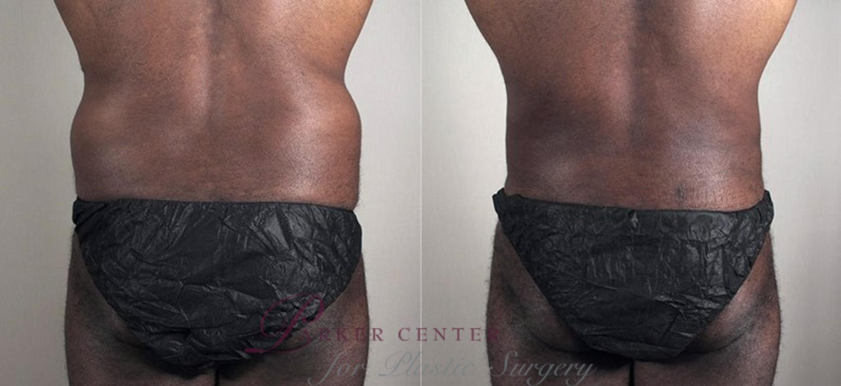 Liposuction Case 805 Before & After View #1 | Paramus, NJ | Parker Center for Plastic Surgery