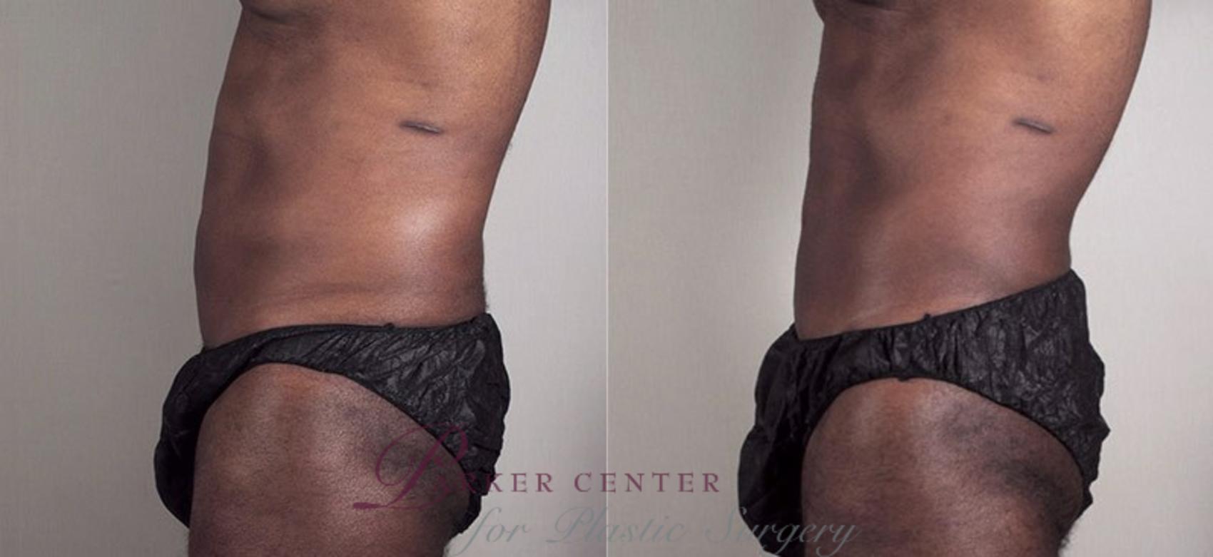 Liposuction Case 805 Before & After View #2 | Paramus, NJ | Parker Center for Plastic Surgery