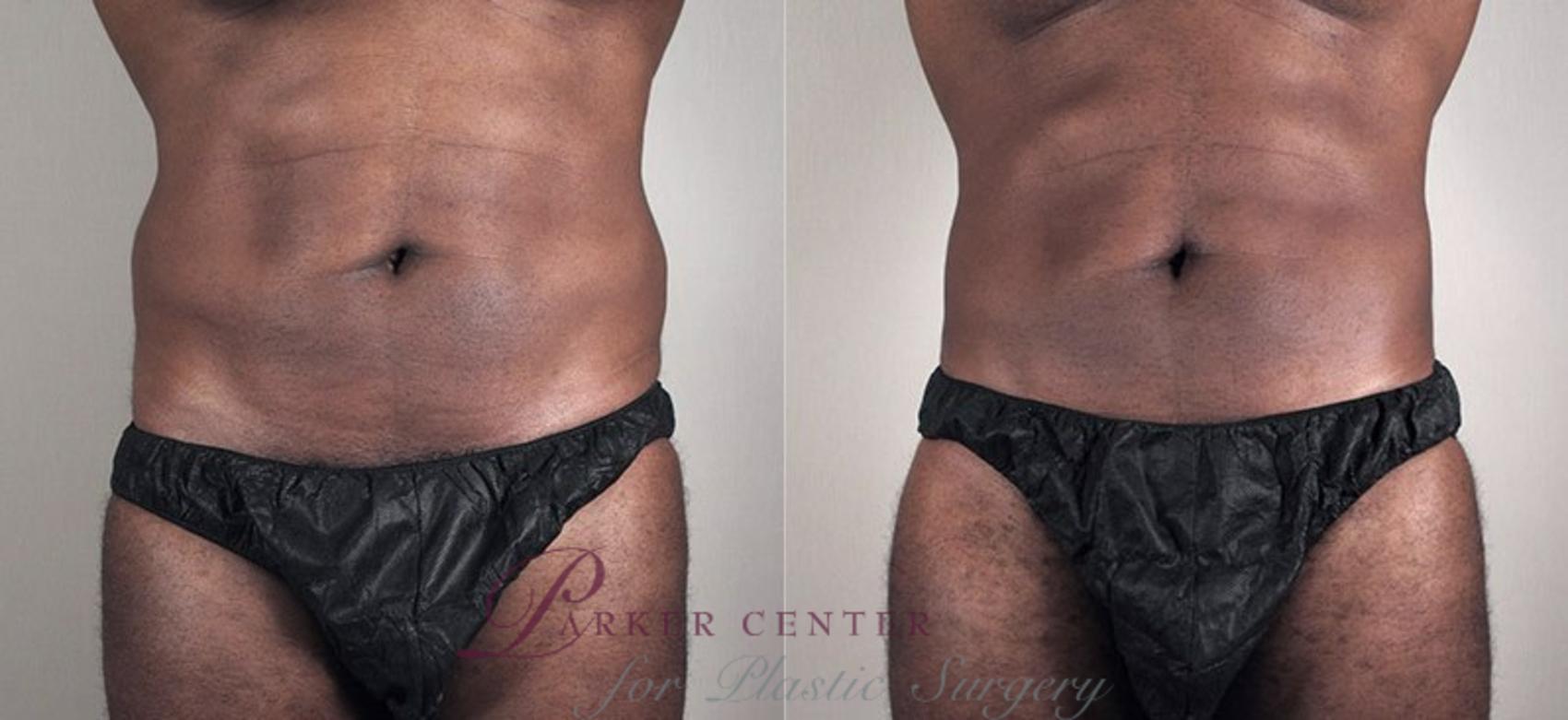 Liposuction Case 805 Before & After View #3 | Paramus, NJ | Parker Center for Plastic Surgery
