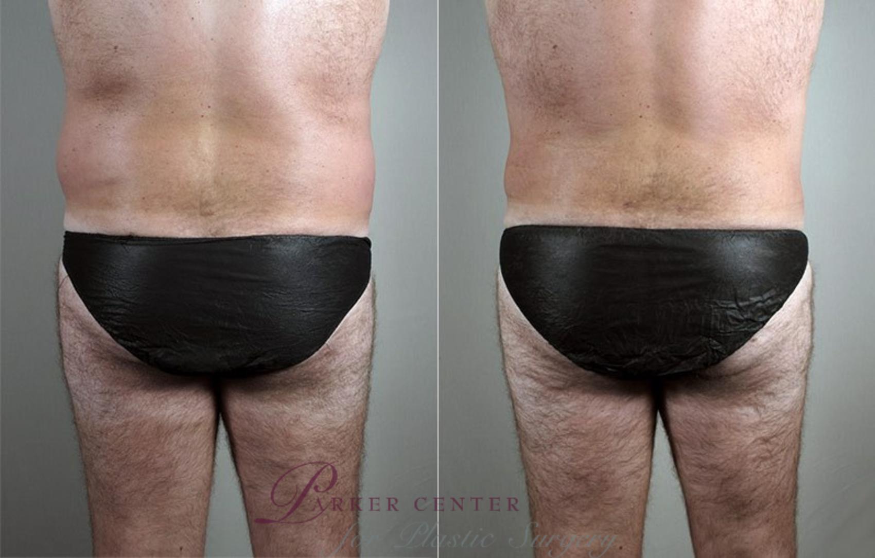 Liposuction Case 806 Before & After View #1 | Paramus, NJ | Parker Center for Plastic Surgery