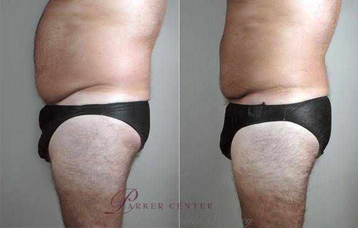 Liposuction Case 806 Before & After View #2 | Paramus, NJ | Parker Center for Plastic Surgery