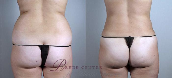 Liposuction Case 807 Before & After View #2 | Paramus, NJ | Parker Center for Plastic Surgery
