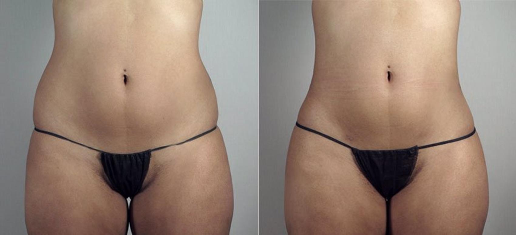 Liposuction Case 808 Before & After View #1 | Paramus, NJ | Parker Center for Plastic Surgery