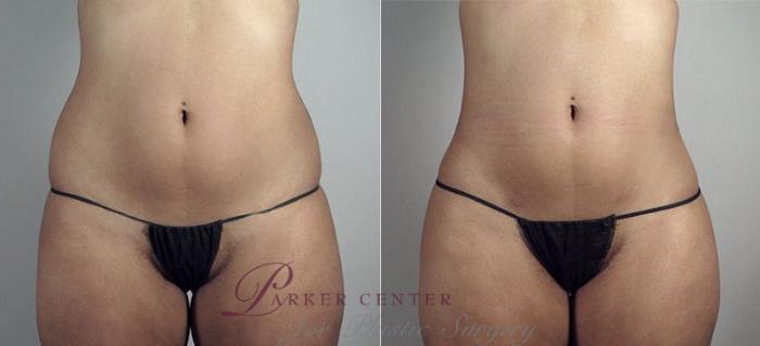 Liposuction Case 808 Before & After View #1 | Paramus, NJ | Parker Center for Plastic Surgery