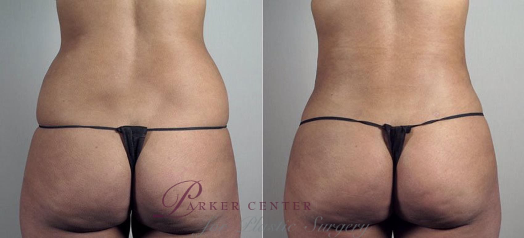 Liposuction Case 808 Before & After View #2 | Paramus, New Jersey | Parker Center for Plastic Surgery