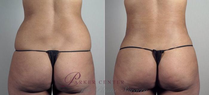 Liposuction Case 808 Before & After View #2 | Paramus, NJ | Parker Center for Plastic Surgery