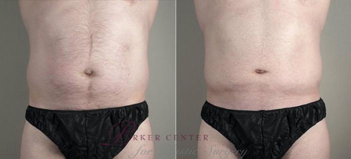 Liposuction Case 809 Before & After View #1 | Paramus, NJ | Parker Center for Plastic Surgery