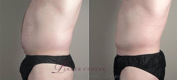 Liposuction Case 809 Before & After View #2 | Paramus, NJ | Parker Center for Plastic Surgery