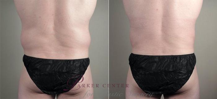 Liposuction Case 809 Before & After View #3 | Paramus, NJ | Parker Center for Plastic Surgery