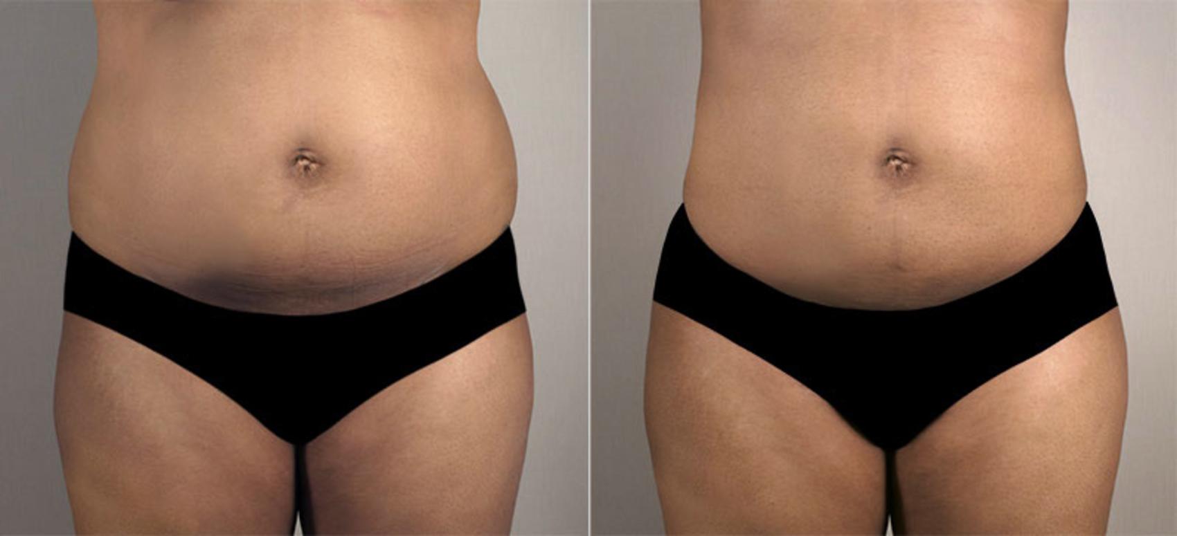 Liposuction Case 810 Before & After View #1 | Paramus, NJ | Parker Center for Plastic Surgery