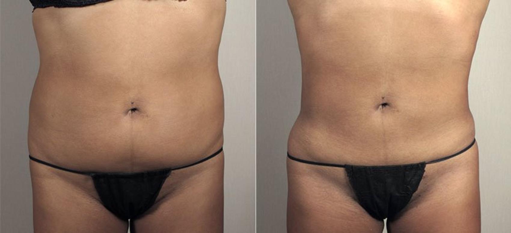 Liposuction Case 811 Before & After View #1 | Paramus, NJ | Parker Center for Plastic Surgery