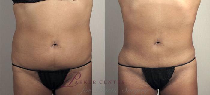 Liposuction Case 811 Before & After View #1 | Paramus, NJ | Parker Center for Plastic Surgery