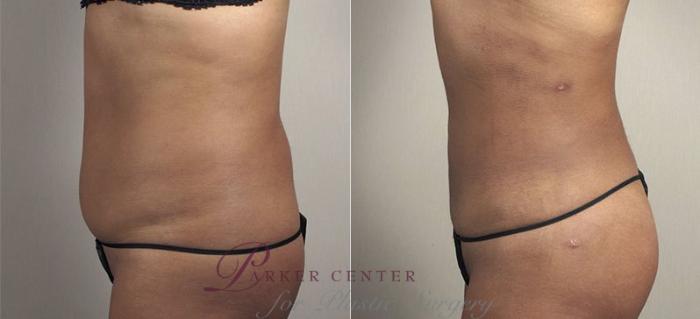 Brazilian Butt Lift Case 811 Before & After View #2 | Paramus, NJ | Parker Center for Plastic Surgery