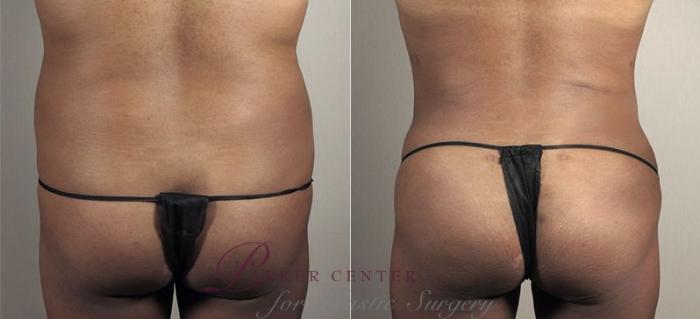 Brazilian Butt Lift Case 811 Before & After View #3 | Paramus, NJ | Parker Center for Plastic Surgery
