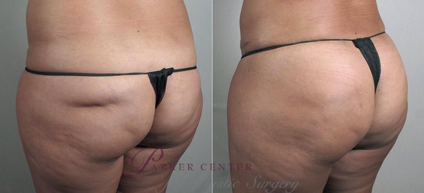 Liposuction Recovery: Depression After Liposuction