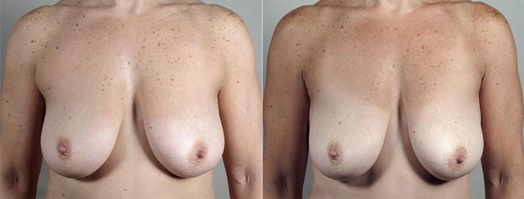 Liposuction Case 813 Before & After View #1 | Paramus, NJ | Parker Center for Plastic Surgery