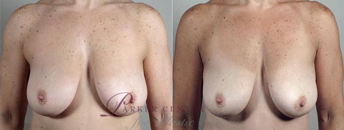 Liposuction Case 813 Before & After View #1 | Paramus, NJ | Parker Center for Plastic Surgery