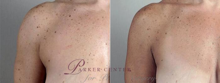 Liposuction Case 813 Before & After View #2 | Paramus, NJ | Parker Center for Plastic Surgery