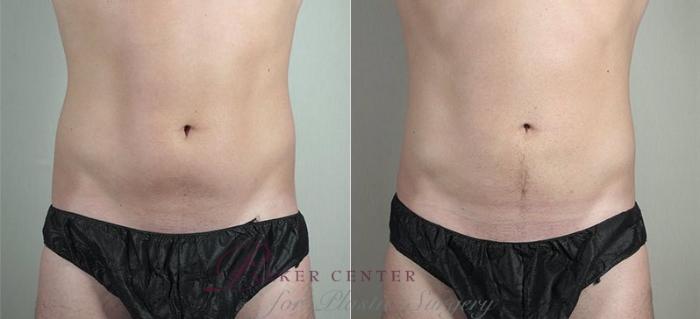 Liposuction Case 815 Before & After View #1 | Paramus, NJ | Parker Center for Plastic Surgery