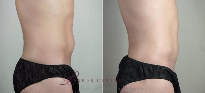 Liposuction Case 815 Before & After View #2 | Paramus, NJ | Parker Center for Plastic Surgery