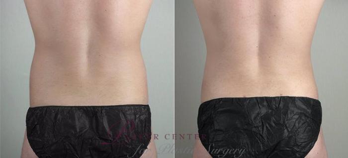 Liposuction Case 815 Before & After View #3 | Paramus, NJ | Parker Center for Plastic Surgery