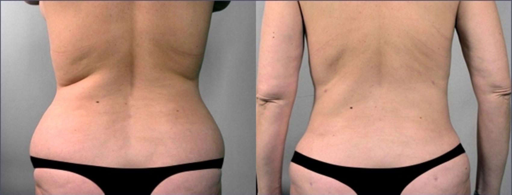 Bra Fat Liposuction with Vaser Lipo Before & After Photos New Jersey -  Reflections Center