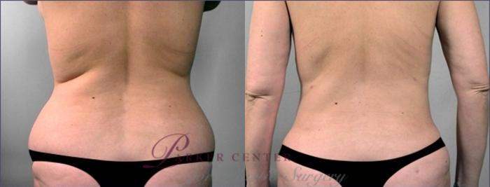 Liposuction Case 918 Before & After View #5 | Paramus, NJ | Parker Center for Plastic Surgery
