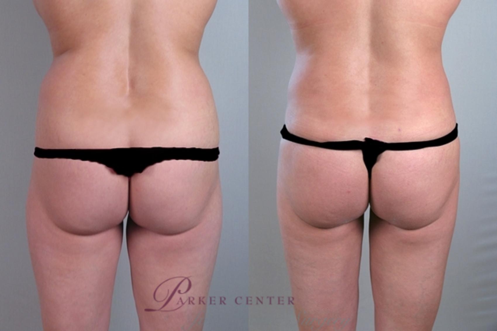 Liposuction Case 924 Before & After View #5 | Paramus, NJ | Parker Center for Plastic Surgery