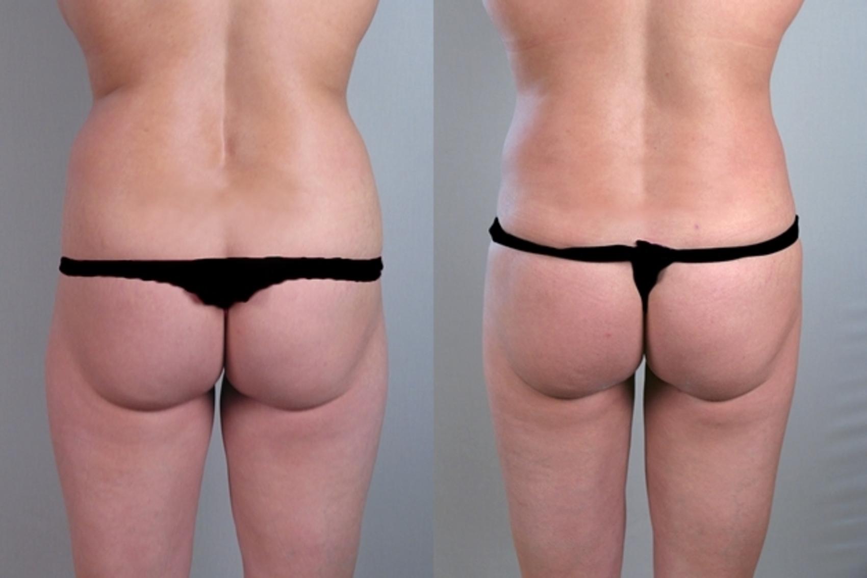 Liposuction Case 924 Before & After View #5 | Paramus, NJ | Parker Center for Plastic Surgery