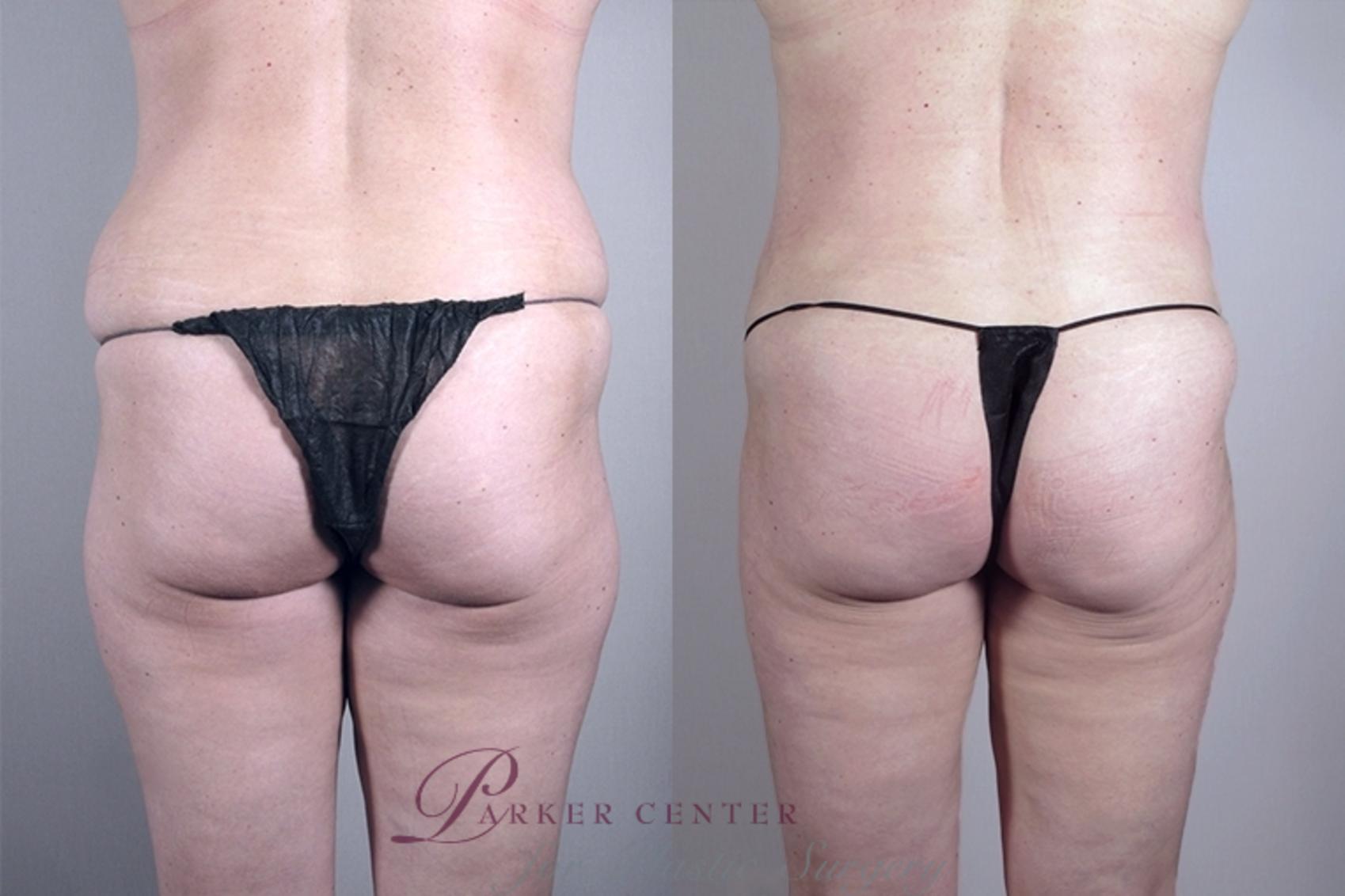 Liposuction Case 925 Before & After View #5 | Paramus, NJ | Parker Center for Plastic Surgery
