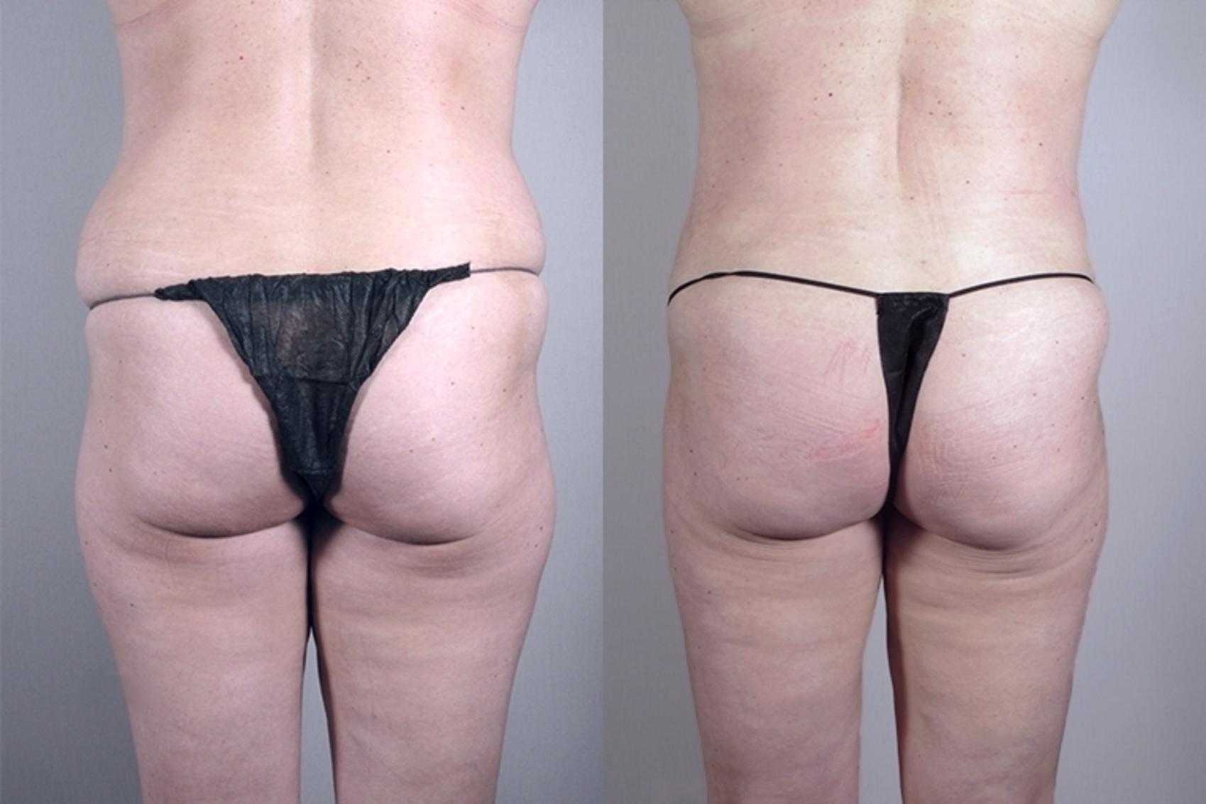 Liposuction Case 925 Before & After View #5 | Paramus, NJ | Parker Center for Plastic Surgery