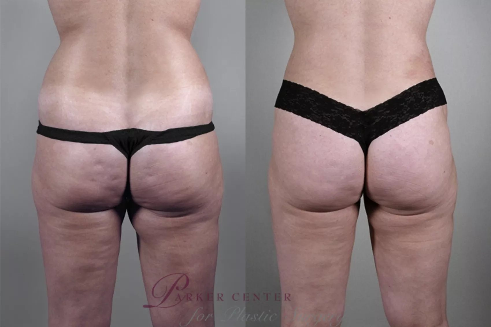 Bra Fat Liposuction with Vaser Lipo Before & After Photos New Jersey -  Reflections Center